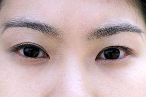 「痛みを最小限に！大阪でのピコレーザーによる刺青除去のメリットと注意点」